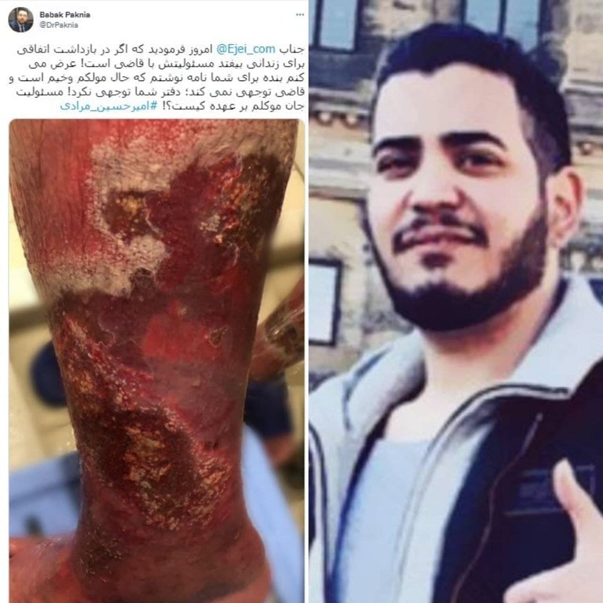 This is a photo of #AmirHosseinMoradi  leg,one of three asylum seekers who fled to #Turkey after 2019 bloody protests in Iran, but were deported by the Turkish government and are currently in prison under the threat of death penalty.