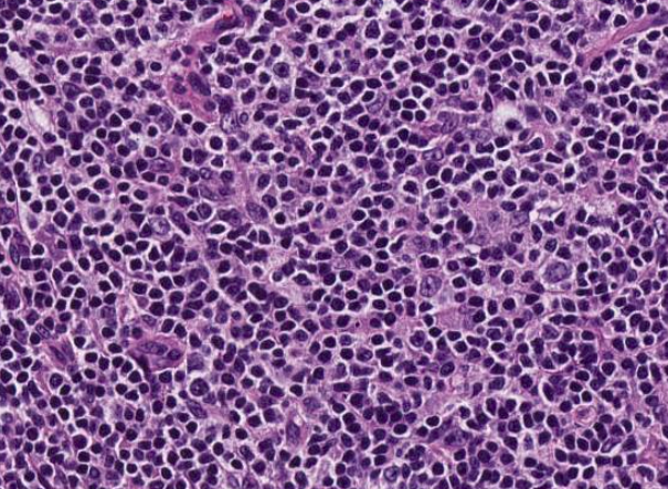 SibaElHussein's tweet photo. #LessonsfromtheFridayUnknowns Nodal MZL replacing follicles and mimicking FL. Clues to dx: Monocytoid cells and disrupted FDC meshworks. Shown by @ljmedeirosMD &amp; @SkybhatiaMD during #LJMFridayUnknowns➡️ https://t.co/CNQyezSNbH @KirillLyapichev @RMirandaMD #hemepath #PathTwitter https://t.co/jl2uOKJ8qS