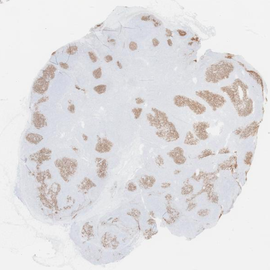 SibaElHussein's tweet photo. #LessonsfromtheFridayUnknowns Nodal MZL replacing follicles and mimicking FL. Clues to dx: Monocytoid cells and disrupted FDC meshworks. Shown by @ljmedeirosMD &amp; @SkybhatiaMD during #LJMFridayUnknowns➡️ https://t.co/CNQyezSNbH @KirillLyapichev @RMirandaMD #hemepath #PathTwitter https://t.co/jl2uOKJ8qS