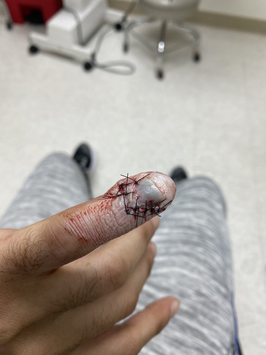 ItzPrimeTimeTv1's tweet image. So I got injured at work and almost lost the tippy top of my pinky. I wanna know some funny ass replies y’all got for me. Lift up my spirits let’s get it #oinky #severed #injured #roastme #nogaming #Severedpinky #workingpain #gaming #gamer #hurt