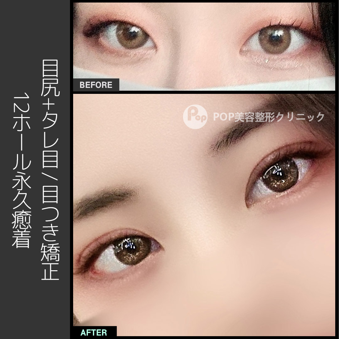 タレ目手術 タレ目手術