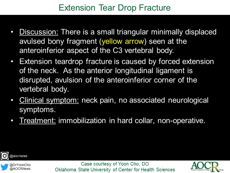 38yo M presents with a neck pain after back flip injury at home
Case courtesy of Yoon Cho, DO <a href="/DrYoonCho/">Yoon Cho, DO</a> | Oklahoma State University of Center for Health Sciences
#radiology #AOCR #MedEd #RadRes #RadFellow #radiologist #radiologylearning #radiologylife #caseoftheweek