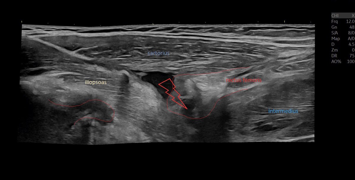 SportklinikBern's tweet photo. Complete rupture of the #rectusfemoris in #mskus #logicview #e10r2 #pocus #pocushub #musclerupture #sportsinjury https://t.co/JwpSz3N7OB