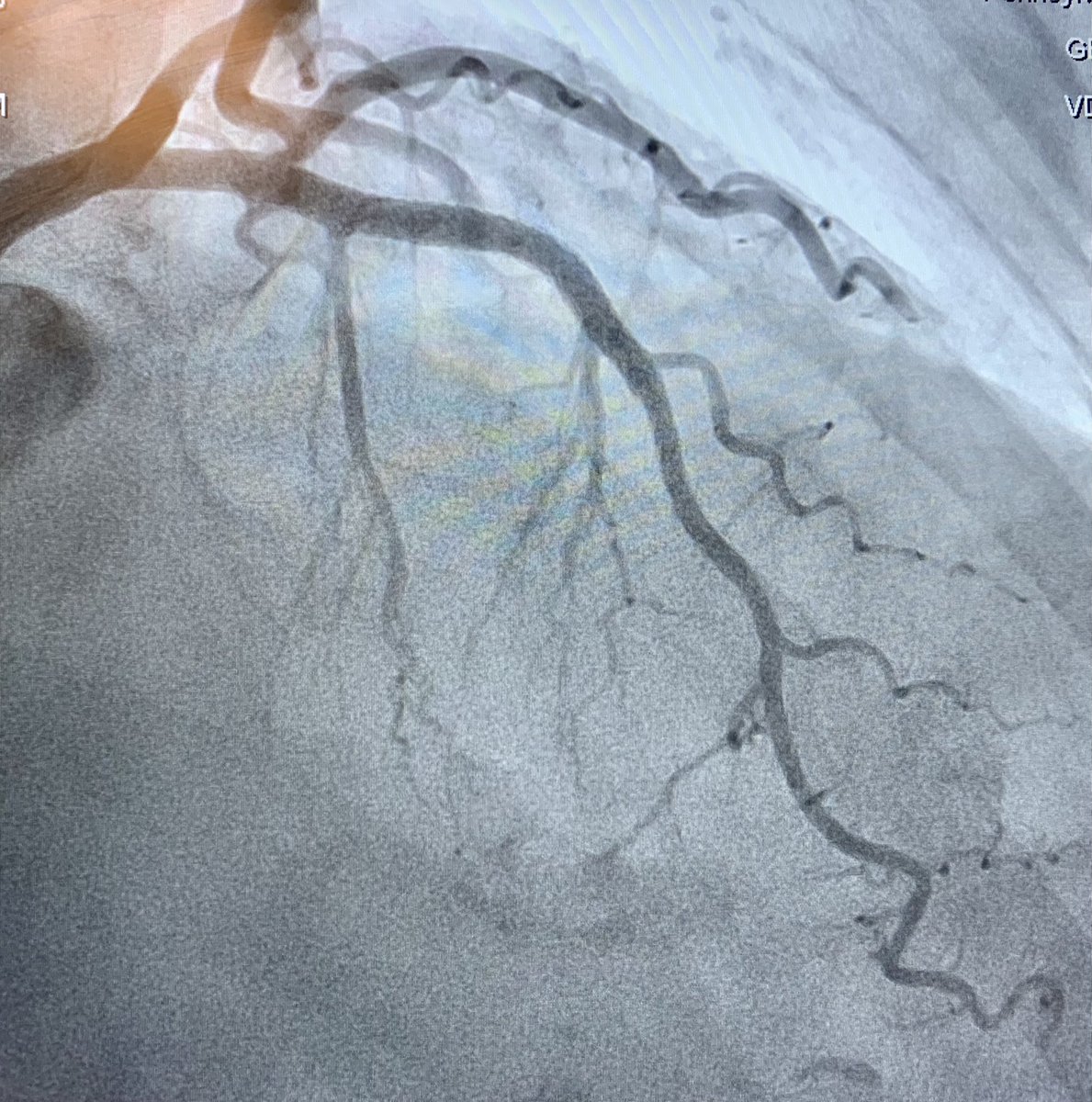 ReVascMed (@revascmed) on Twitter photo Another successful #CTOPCI using Crossboss and wire escalation for #ADR topped off with #IVL for a calcified blunt cap with excellent results. #PennsyInterventions <a href="/jcgeorgemd/">Jon George</a> <a href="/GPAngioClub/">Phila Angio Club</a> <a href="/ACVCPhila/">Academy for CardioVascular Collaboration</a> <a href="/PennCardiology/">Penn Cardiology</a> <a href="/PennCVFellows/">Penn Cardiology Fellows</a> <a href="/BSCCardiology/">BostonSci Cardiology</a> <a href="/ShockwaveIVL/">Shockwave Medical</a> Another successful #CTOPCI using Crossboss and wire escalation for #ADR topped off with #IVL for a calcified blunt cap with excellent results. #PennsyInterventions <a href="/jcgeorgemd/">Jon George</a> <a href="/GPAngioClub/">Phila Angio Club</a> <a href="/ACVCPhila/">Academy for CardioVascular Collaboration</a> <a href="/PennCardiology/">Penn Cardiology</a> <a href="/PennCVFellows/">Penn Cardiology Fellows</a> <a href="/BSCCardiology/">BostonSci Cardiology</a> <a href="/ShockwaveIVL/">Shockwave Medical</a>