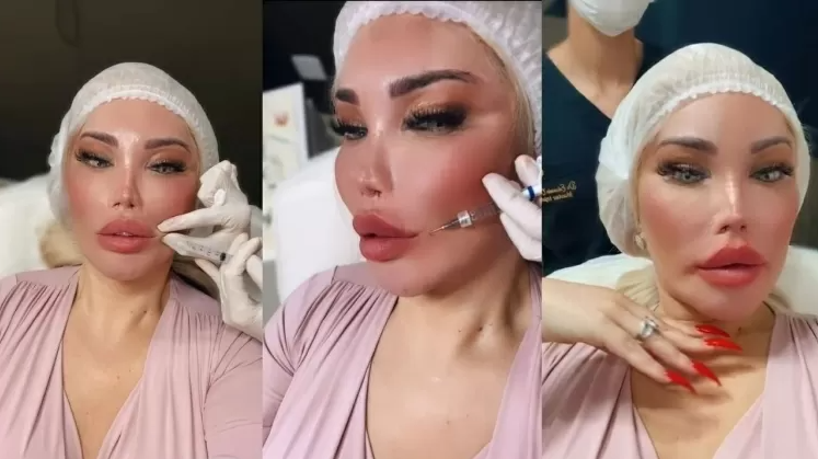 imirante's tweet image. &apos;Ficou super bonito&apos;, diz Jessica Alves após realizar preenchimento labial imirante.com/524968 #JessicaAlves #PreenchimentoLabial #influenciadora #ProcedimentoEstético (Foto: Reprodução/Rede Social)
