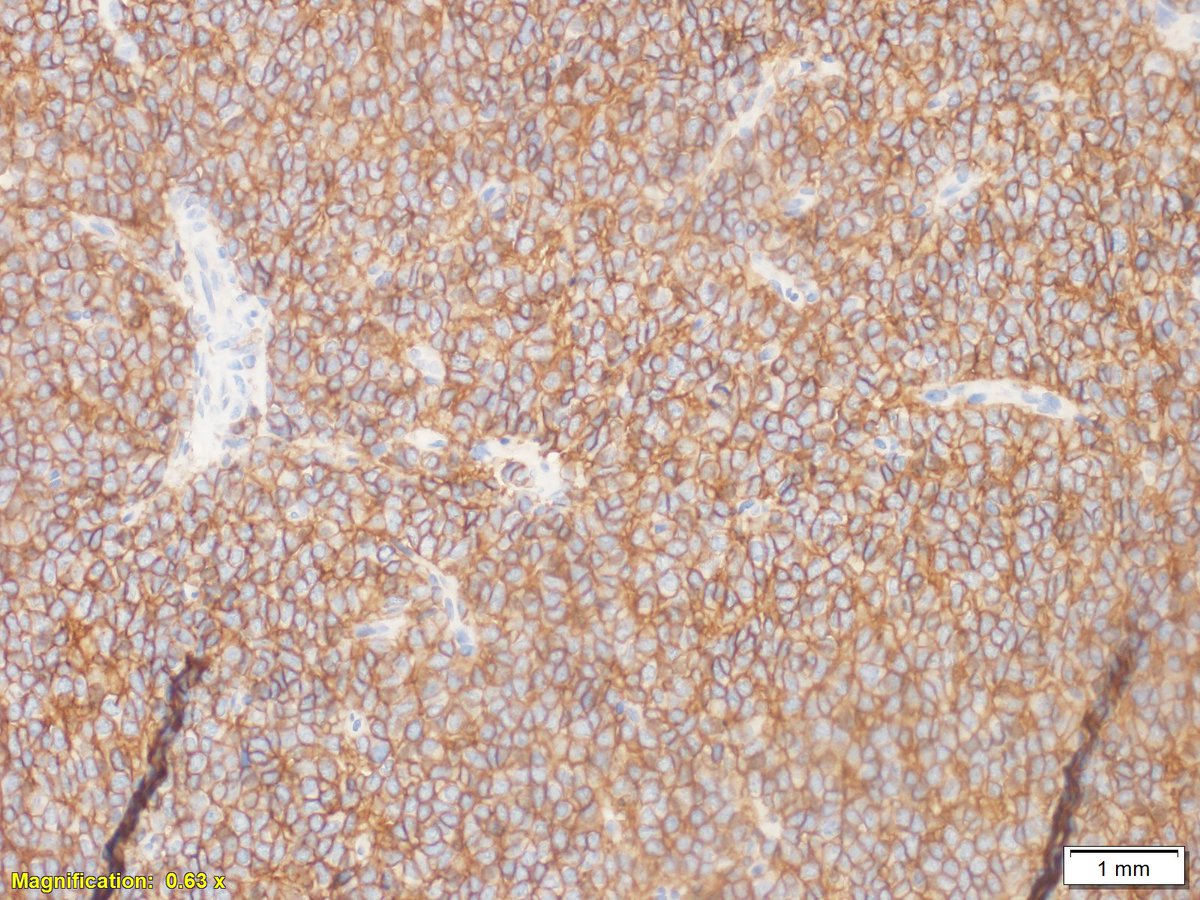wfupathologist's tweet photo. Primary Ewing's sarcoma of the lung. Positive CD99 by IHC. Positive t(11;22)/EWSR1-FLI1 fusion. Presented at pediatric tumor board, courtesy of Dr. Haiyan Lu. #PathTwitter #PulmPath https://t.co/B0RdPSEBRE