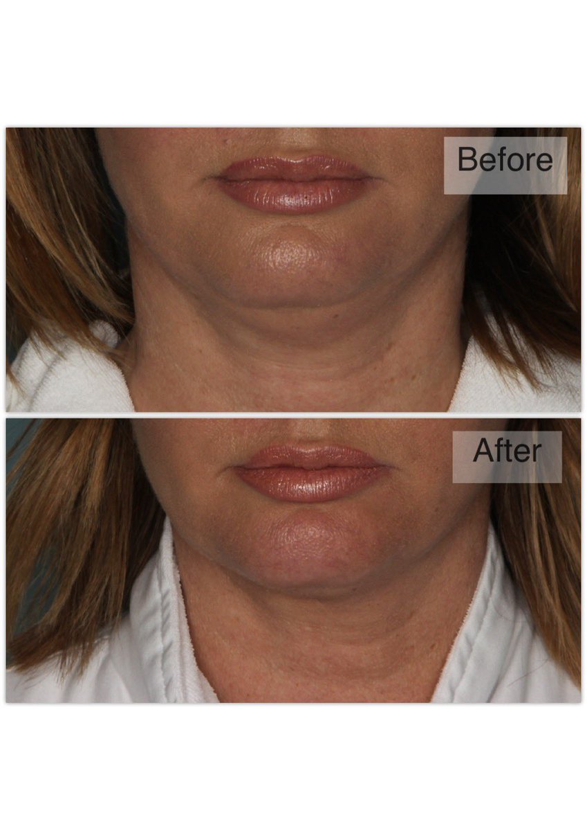 JeffreyCDawesMD's tweet image. Feeling self-conscious about a double chin? Belkyra will break down fat in targeted areas under the chin and it’s permanent! Send us a DM to learn more. #belkyra #fatreduction #chinfat #calgaryplasticsurgery #plasticsurgeon