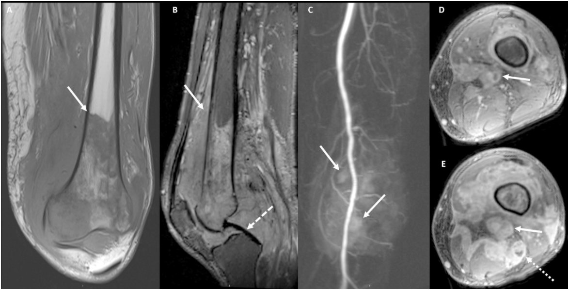 Primary Lymphoma of the Distal Femur Presenting as Spontaneous Deep Vein Thrombosis and Knee Monoarthritis ow.ly/Mt2250Gayj7