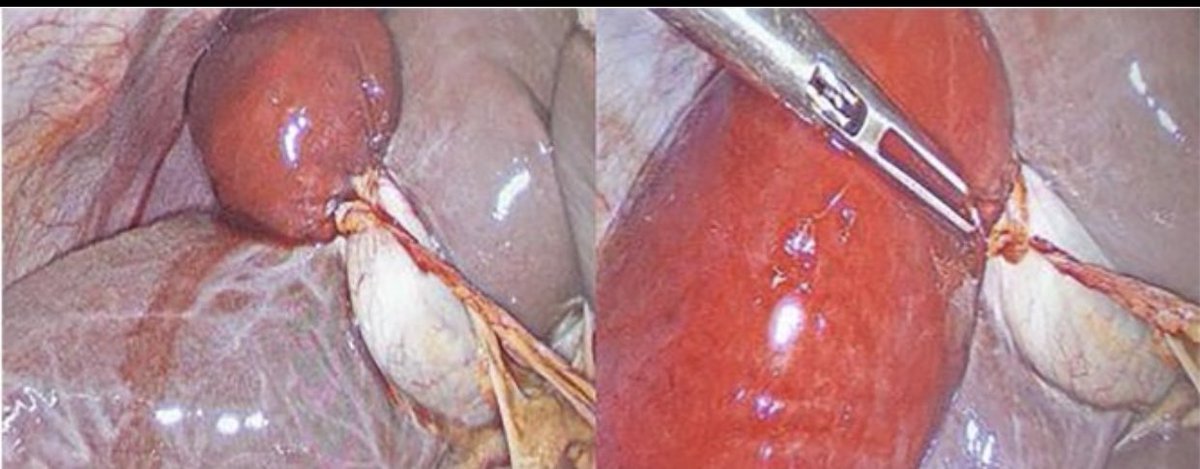 10bladeae's tweet photo. Its #FIOF time!! A 26 y/o male presented to ED with cramped abdominal pain in the RUQ associated with vomiting. What is your diagnosis? Head over to https://t.co/m9m3amRIFz and give it a go! #SoMe4Surgery #SurgicalResident #Dubai #generalsurgery #imagechallenge #10bladeae #TGIF https://t.co/AHiM8vleVK