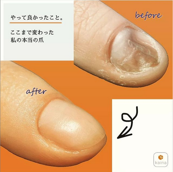 爪のお悩みはプロギタリストもご愛用のナチュラルネイルケア 特典 メール診断無料アドバイス付 V Twitter 弊社は爪 のトラブルを専門に向き合うこと25年 色々な爪の症状の施術を行ってきましたが 10年前から商品を発売して皆さまにご自身でケアをいただけるように 爪のお悩みはプロギタリストもご愛用のナチュラルネイルケア 特典 メール診断無料アドバイス付 V Twitter 弊社は爪 のトラブルを専門に向き合うこと25年 色々な爪の症状の施術を行ってきましたが 10年前から商品を発売して皆さまにご自身でケアをいただけるように
