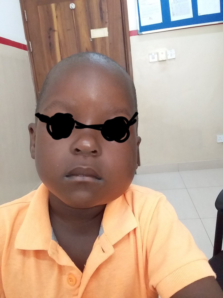 Paed Clinics of Dar, Tanzania 
#Mumps: a contagious viral illness preventable by vaccination. Treatment: there is no specific antiviral treatment for mumps. Management is largely symptomatic with analgesia +/- cold or warm pack application.