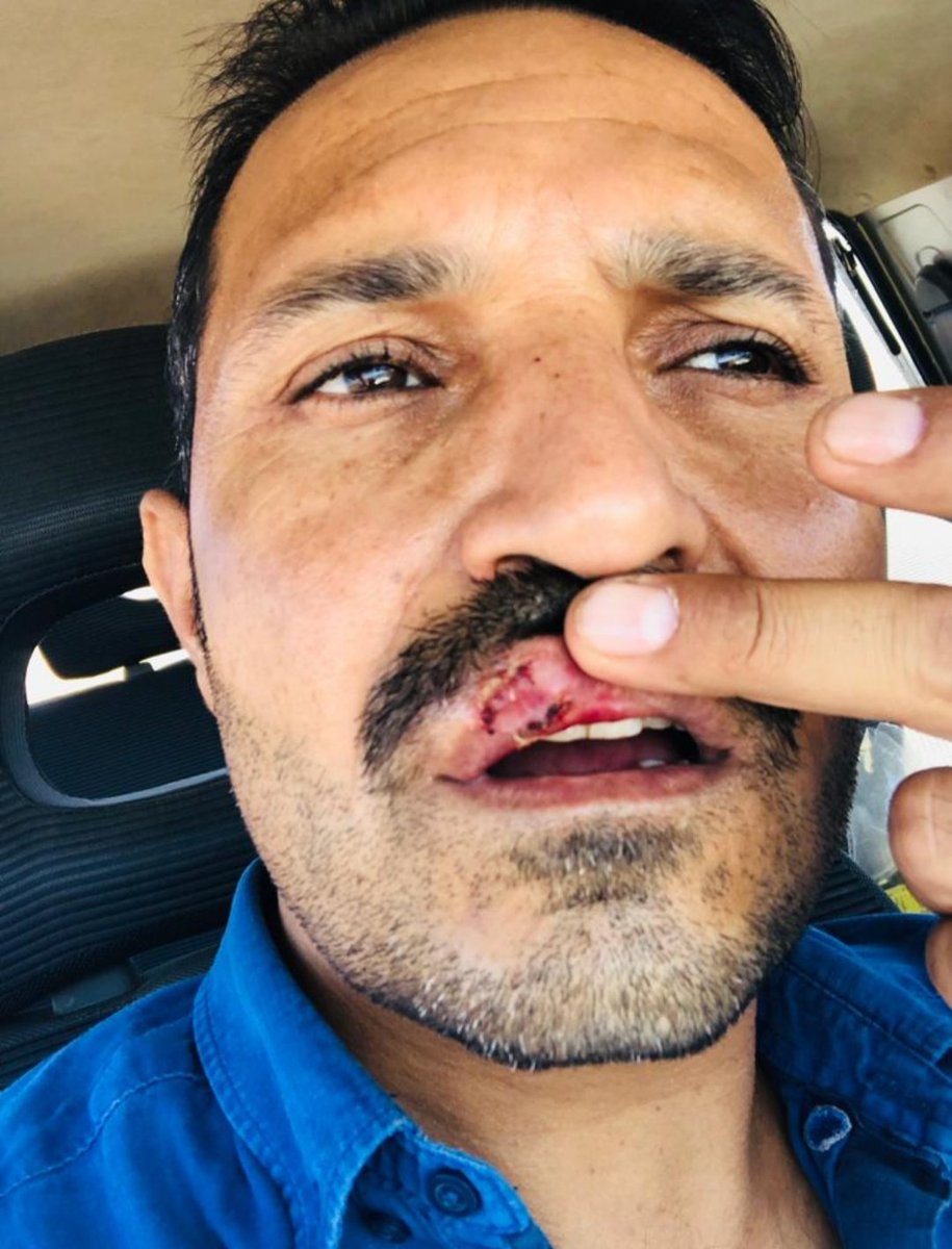 Suruç Tarım ve Orman İlçe Müdürlüğünde görevli meslektaşımız Mahmut SÜMER Yağışlı mahallesinde aşı uygulaması sırasında aldığı boynuz darbesi sonucu yaralanmıştır.Hastanede yapılan müdahale sonrası meslektaşımıza 8 dikiş atılmıştır.
Kendisine geçmiş olsun dileklerimizi sunuyoruz.