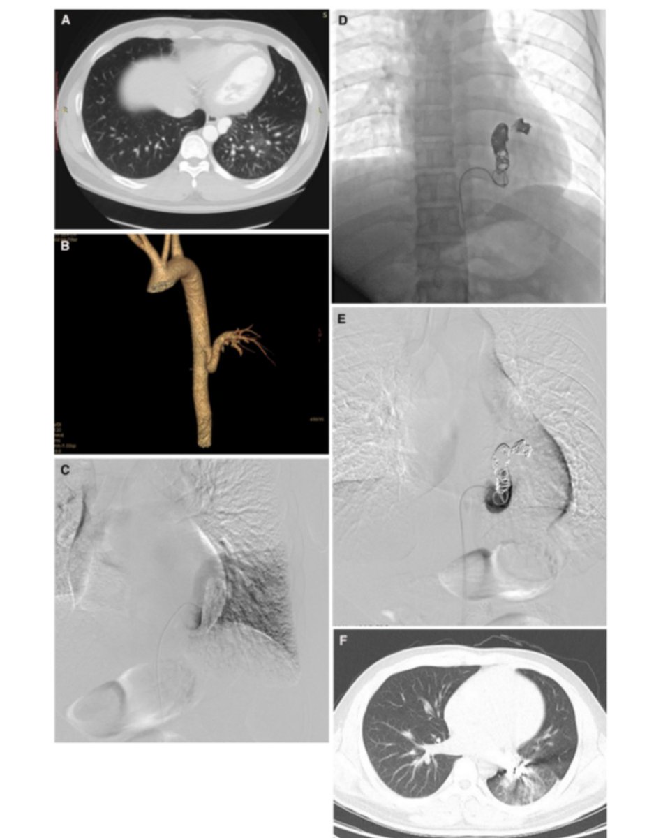 Make sure you don't miss this #ShortCommunication: Clinical Outcomes of Transarterial #Embolization in the Treatment of Pulmonary Sequestration
link.springer.com/article/10.100…