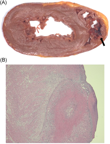 onlinelibrary.wiley.com/doi/10.1111/jo…
Acute RV failure in a patient with nonischemic #cardiogenicshock on left-side #MCS @CarlyFabrizio @CatalinPToma @jafwlr @ParmjeetRandha5 @GavHick @JCardSurg @PittCardiology @InstituteStarzl #pathology #transplantation #cardiotwitter #CardioEd #CardioNews