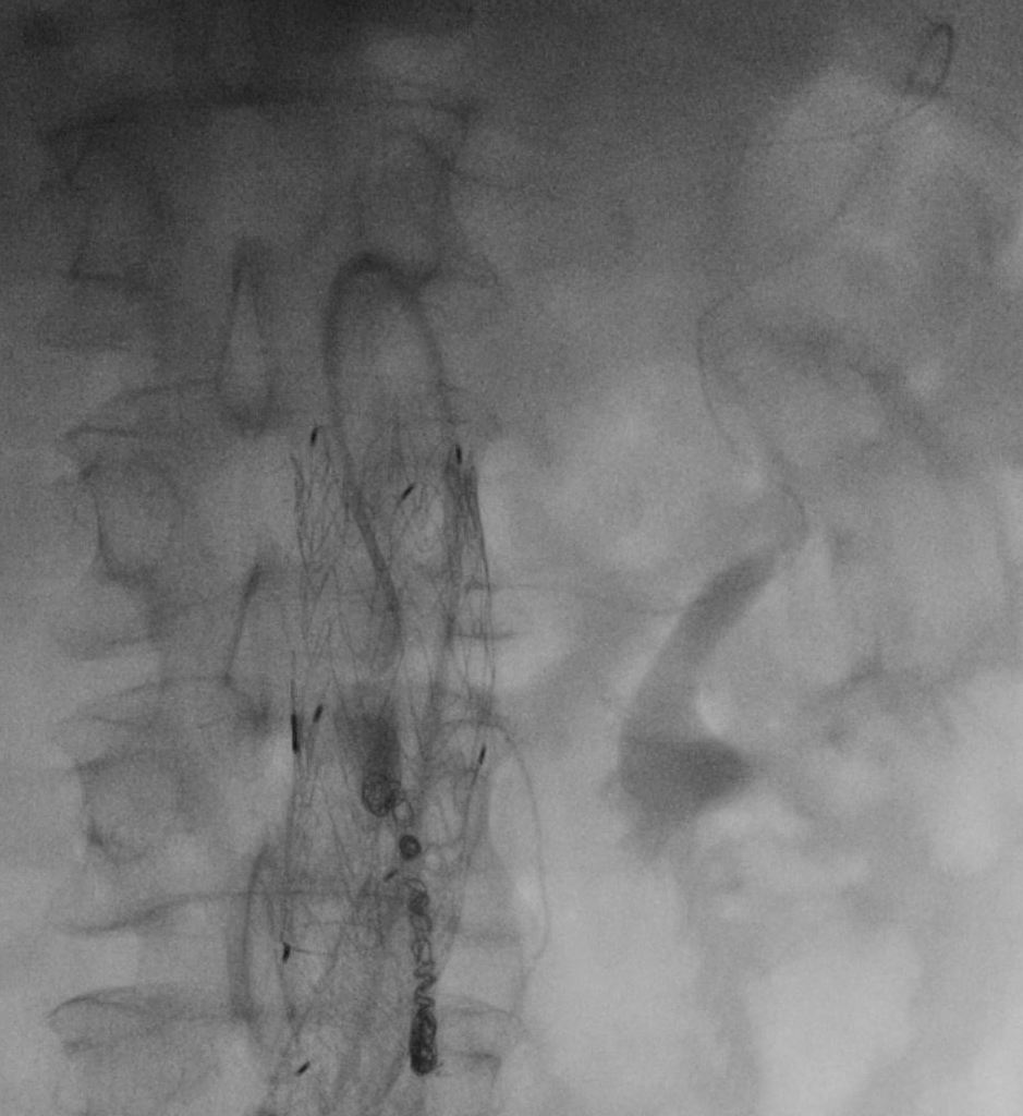 michaeldburns's tweet photo. Type 2 #endoleak supplied by IMA and bilateral accessory renal arteries - note the lower pole renal infarcts on pre procedure CT. Treated via #embolization using SMA-->IMA approach via arc of Riolan.
#irad #minimallyinvasive
@CAIRweb @SIR_ECS https://t.co/CG7CpsjGgW