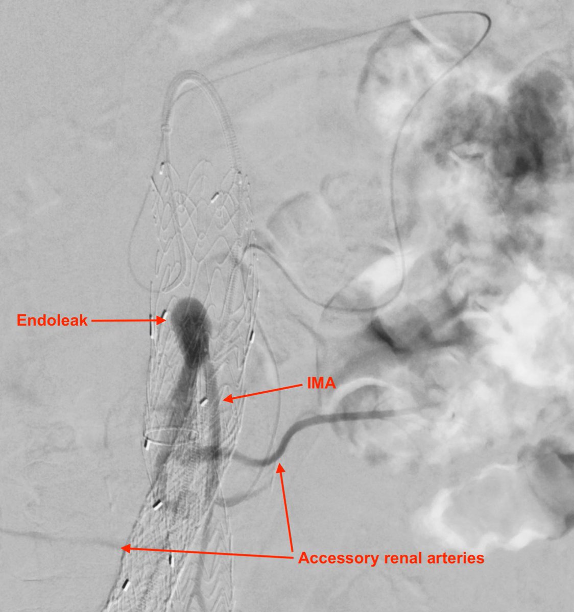 michaeldburns's tweet photo. Type 2 #endoleak supplied by IMA and bilateral accessory renal arteries - note the lower pole renal infarcts on pre procedure CT. Treated via #embolization using SMA-->IMA approach via arc of Riolan.
#irad #minimallyinvasive
@CAIRweb @SIR_ECS https://t.co/CG7CpsjGgW