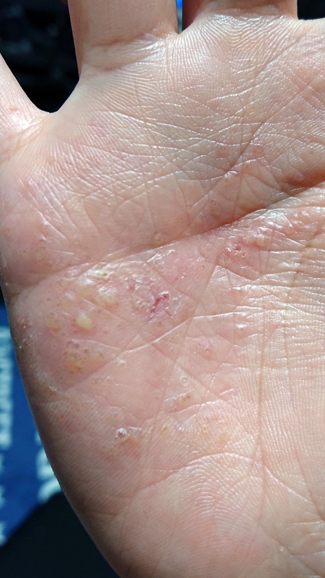 銀次郎さん 他 また汗疱悪化 今は痒くて痛い 汗疱 T Co 5vhlsg5fxg Twitter