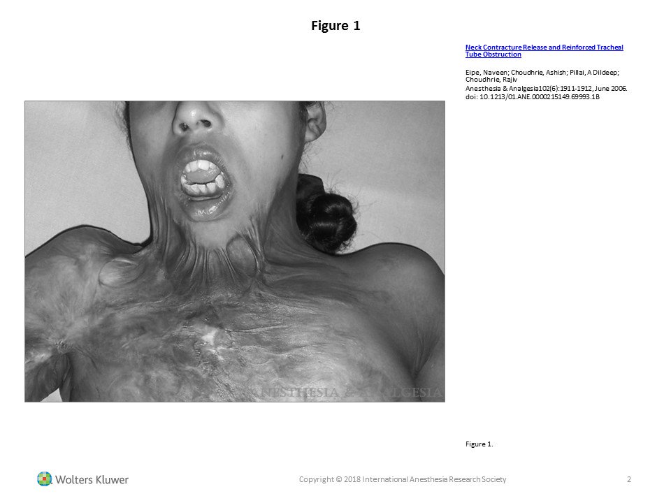 NaveenEipe's tweet image. Till recently, 
amongst all the H&amp;amp;N Ca, submental &amp;amp; retromolar intubations, Burn contractures, and Trauma, etc.
 
this AS+DISH was the most challenging!
ncbi.nlm.nih.gov/pmc/articles/P…

[PMID-15781548,  16492871, 16717362, 17263744  etc.] #SelfCitation #DiffAWs