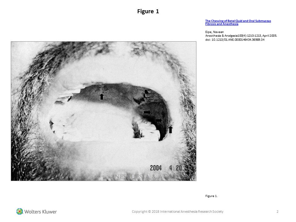 NaveenEipe's tweet image. Till recently, 
amongst all the H&amp;amp;N Ca, submental &amp;amp; retromolar intubations, Burn contractures, and Trauma, etc.
 
this AS+DISH was the most challenging!
ncbi.nlm.nih.gov/pmc/articles/P…

[PMID-15781548,  16492871, 16717362, 17263744  etc.] #SelfCitation #DiffAWs