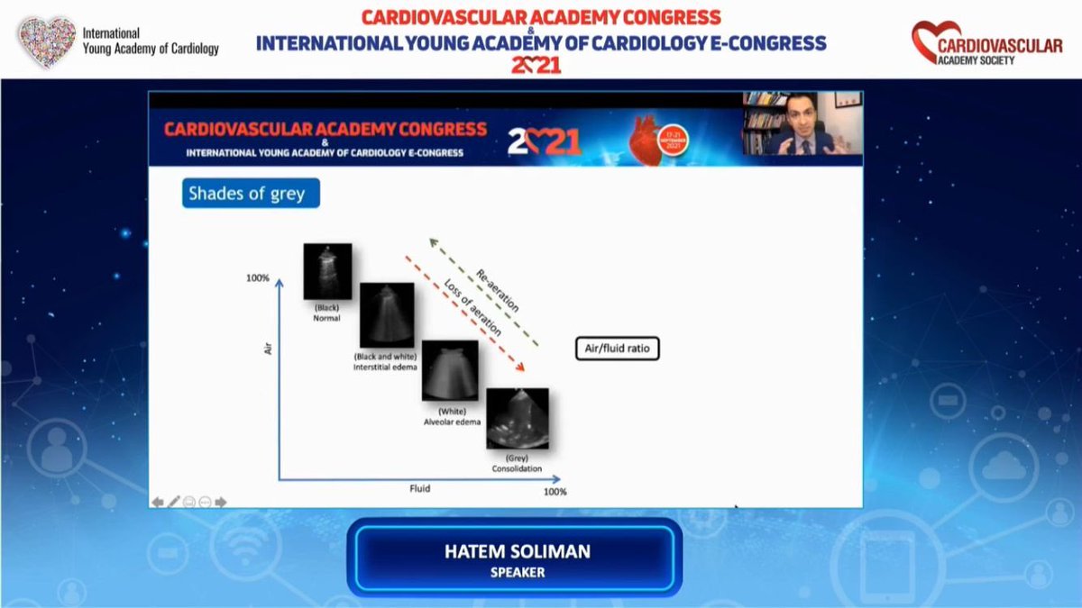 In the cutting-edge world, Covid-19 is the most significant concern for everyone. Lung Ultrasound in this Era is most useful tool for diagnosis and risk stratification. Thanks to Hatem Soliman for his comprehensive presentation. #IYAC2021 @hatemsoliman @KemalogluOz