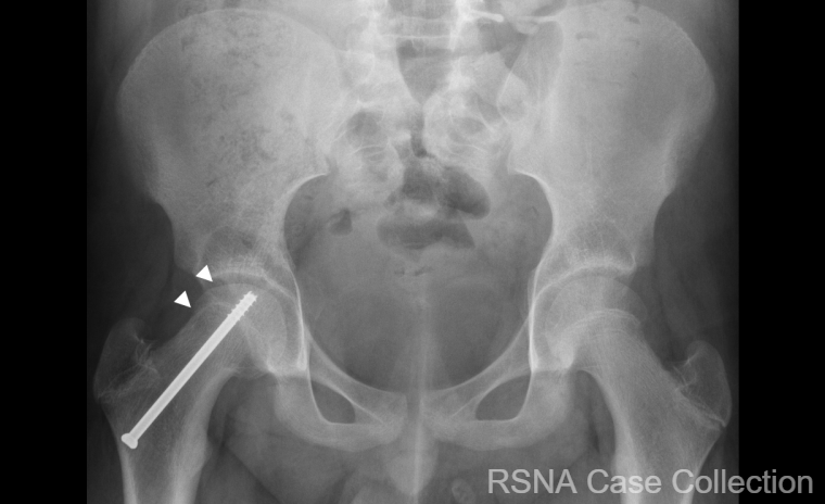 PGSharmaMD's tweet photo. Hopefully you didn’t “screw” up this weeks #RSNACC COW!   

Answer: https://t.co/iFAmviAC02 

Thanks @RSNA #RSNACC #MSKRad Deputy Ed Dr Kumaravel @MKMSKER @UTRadRes &amp; authors Drs. Tidwell and Saade and Amanda Schaaf! @uazmedphx @UAZHealth @CreightonPHX @valleywise_az @UofAZRads https://t.co/eAVy0FWZr9