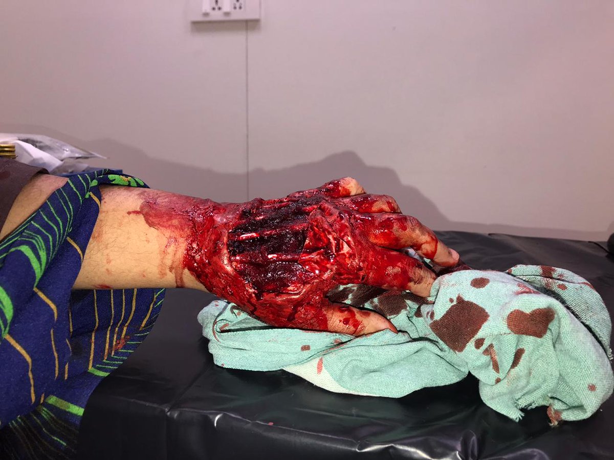 Glad to showcase our best moulage <a href="/IPSSorg/">IPSS</a> as part of #hcsimweek21 . 
Entry by Lulu Sherif Mahmood/ Father Muller Simulation and Skill Centre, India /#lulusherif 
Themed for Awareness against Acid Attacks in India. Moulage by Sim Tech Pradeep &amp; Sim Educator Nicole. Model : Lulu