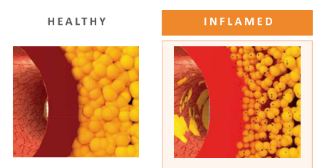 Did you know? 🫀 Coronary inflammation causes changes in the size & composition of perivascular adipose tissue surrounding the coronary arteries, even before plaques are visible on CCTA #cardiotwitter #heartattack