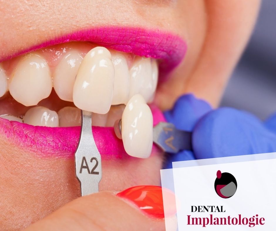 dimplantologie's tweet image. 😁 La #ResinaCompuesta es un material del color de los #dientes que también se utiliza para empastes dentales. Este material, después de aplicarlo sobre su superficie y los bordes, puede moldearse y pulirse para imitar #DientesNaturales.

🔷Utilizamos los #mejores materiales.
