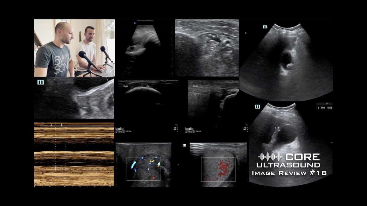 Jailyn/Ben (@coreultrasound) on Twitter photo Core Ultrasound Image Review, Episode 18!
This week, <a href="/EMedCurious/">Michael Macias</a> and Jacob sit down to discuss some choice cases.
Check it out here: coreultrasound.com/cuir_18/
#FOAMed
#POCUS Q-bank here: courses.coreultrasound.com/collections?ca…
Sound & Surf Conference rego here: soundandsurf.com Core Ultrasound Image Review, Episode 18!
This week, <a href="/EMedCurious/">Michael Macias</a> and Jacob sit down to discuss some choice cases.
Check it out here: coreultrasound.com/cuir_18/
#FOAMed
#POCUS Q-bank here: courses.coreultrasound.com/collections?ca…
Sound & Surf Conference rego here: soundandsurf.com