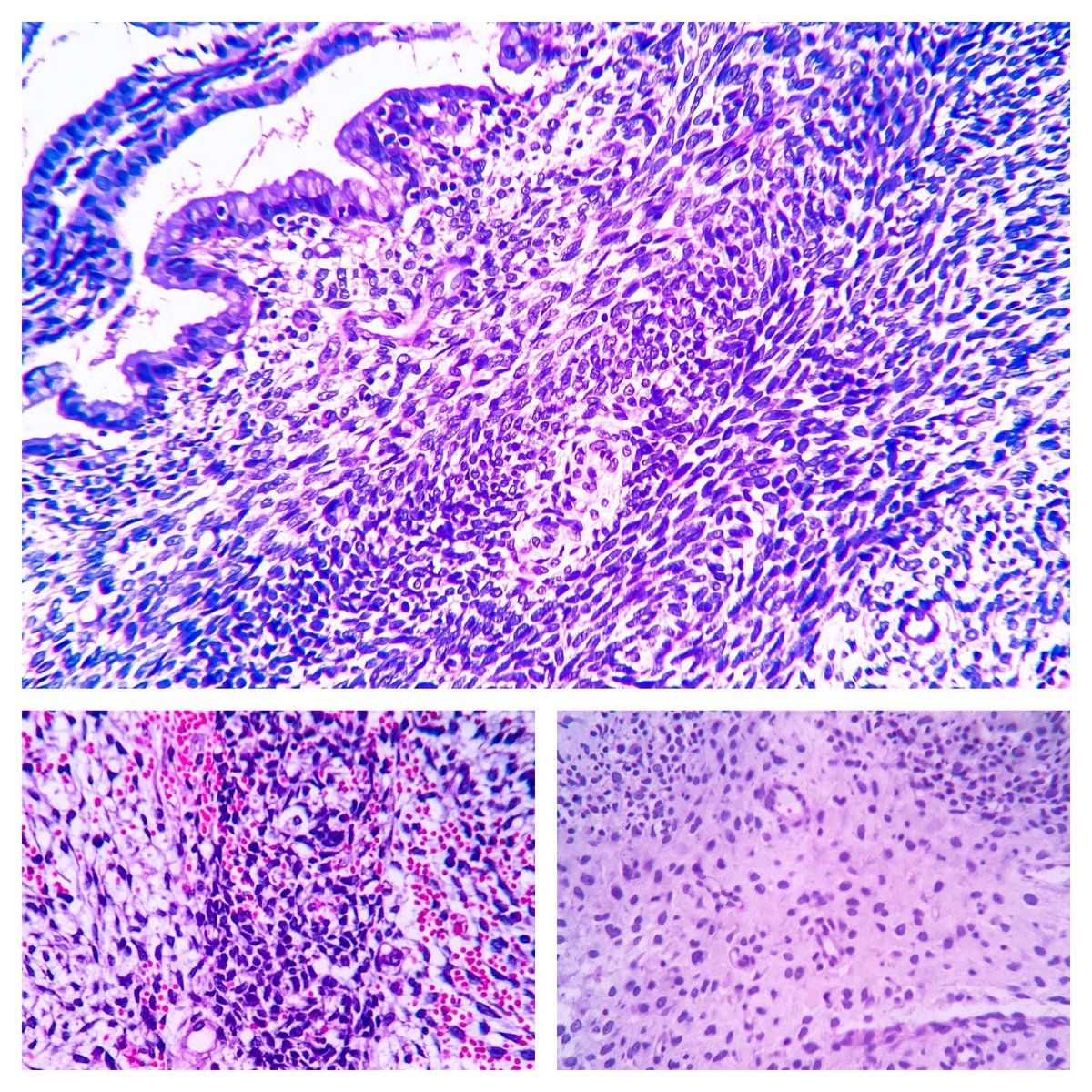 EIacovou's tweet image. 40 yo female with vaginal hemorrhage and a protruding mass from the uterine cervix. #pathology #twitterpath