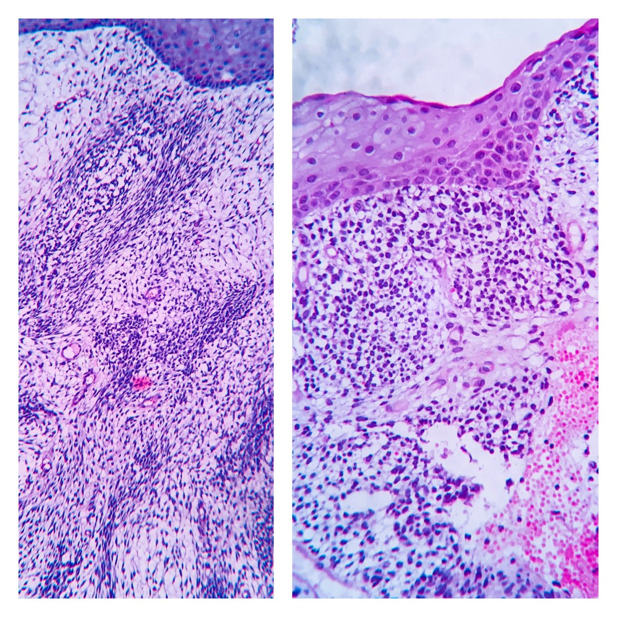 EIacovou's tweet image. 40 yo female with vaginal hemorrhage and a protruding mass from the uterine cervix. #pathology #twitterpath