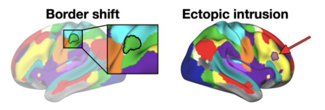 Caterina Gratton (@grattoncaterina) on Twitter photo Are all individual differences in 🧠 systems driven by local shifts in network boundaries? A new lab preprint led by <a href="/allydworetsky/">Ally Dworetsky</a> argues no ⛔️:
bit.ly/2Zksvkx
We find evidence that isolated "ectopic intrusions" are also common and dissociable from border shifts. Are all individual differences in 🧠 systems driven by local shifts in network boundaries? A new lab preprint led by <a href="/allydworetsky/">Ally Dworetsky</a> argues no ⛔️:
bit.ly/2Zksvkx
We find evidence that isolated "ectopic intrusions" are also common and dissociable from border shifts.