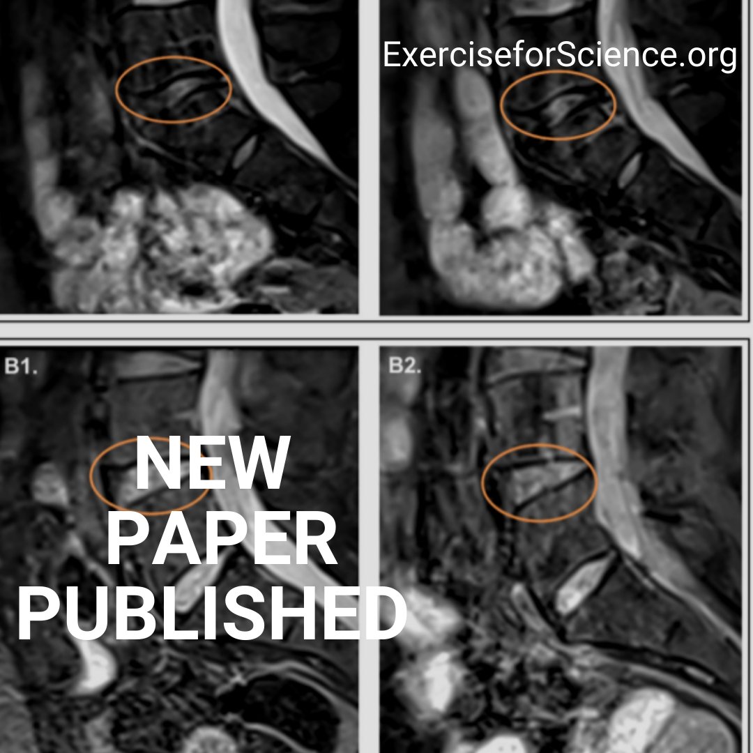 Running4Science's tweet image. New study released! Our third piece of research based on Richmond #marathon participants found that 500 miles of #running does not damage or acutely change your spine. Read the paper here: exerciseforscience.org/hip