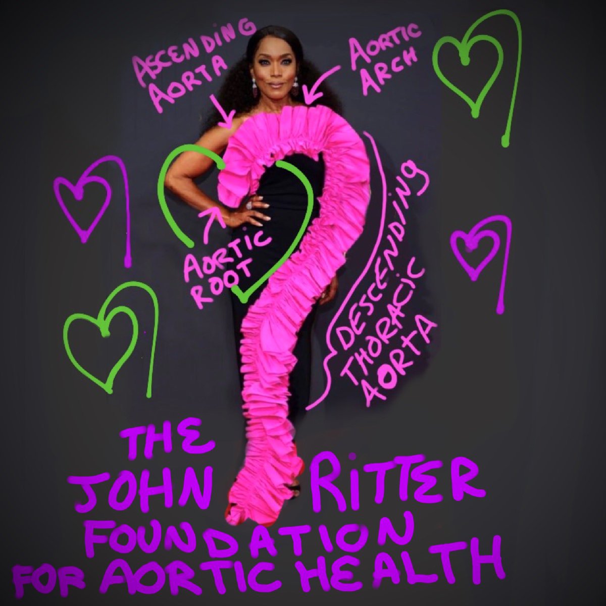 #AorticDissectionAwarenessWeek #aortasupporta #johnritter #MedTwitter #aortaEd #HowMyAortaGotItsGrooveBack @JohnRitterFdn @SarahKSilverman @AorticDissectCT