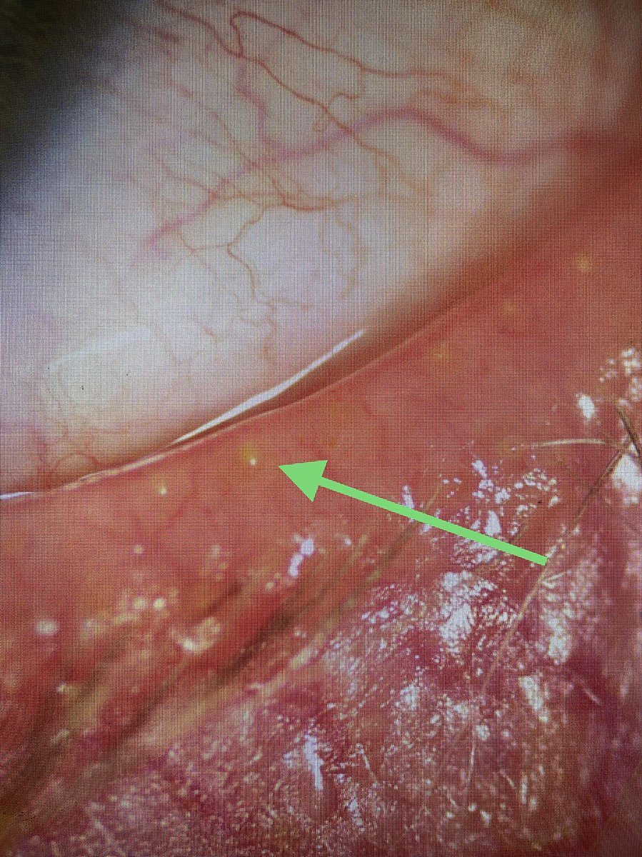 #blepharitis and meibomian gland dysfunction are very common problems that lead to dry eye and can cause chronic problems. #Blephex lid hygiene is a very helpful treatment similar to seeing a dental hygienist every year to keep the lids in good condition. <a href="/oclvision/">OCL Vision</a>