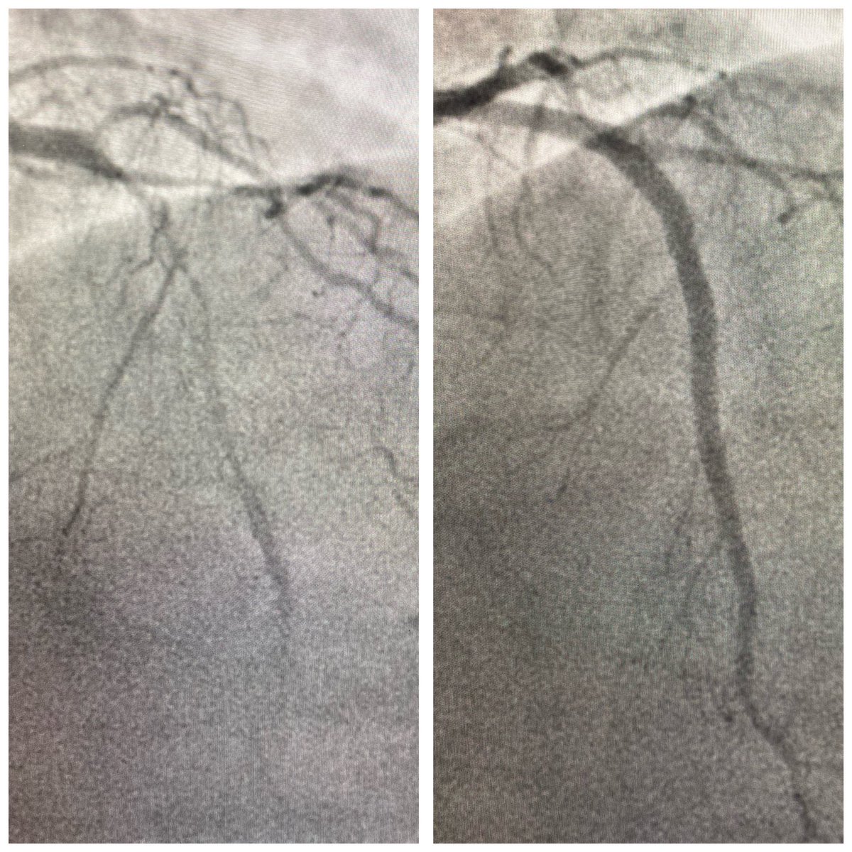 w_jyg's tweet image. First #RotaPro use in our centre.
#ESRD Diffuse heavily #calcified LAD
#IVUS near 360 
1.5 #burr #170krpm x 5 runs 
NC 3.0, #DES x2 , NC 4.0 
@bostonsci @PCRonline @BotPci 
Best thing, to view a replay #EuroPCR #Rota session afterward ☕️ 
#FromBenchToBedside