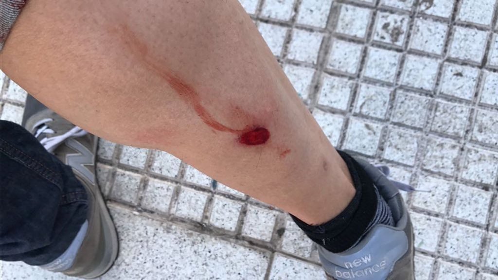 0800CarlosMenem's tweet photo. Recién en el Obelisco la policía de @alferdez  empezó a reprimir con balazos. Esto le paso a uno que estaba a dos metros mio. Difundir para que despues no se llenen la boca. #BanderazoNacional #Obelisco #Cacerolazo #20JYoVoy https://t.co/dvtULWuKN1