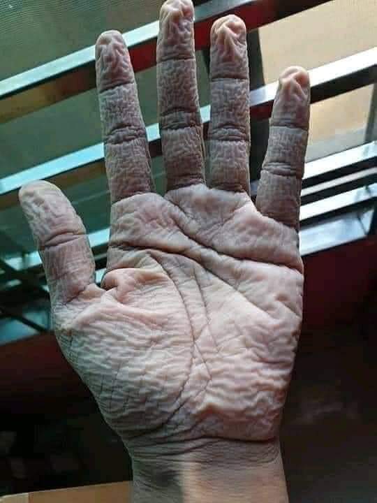 The hand that protects us. This is the hand of every doctor, every nurse, every healthcare worker after they remove gloves & PPEs following long hours of COVID duty.