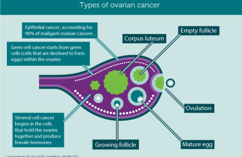 So when they talk about ovarian cancer they list the three (3) most common location (type of cell) they start from:- epithelial- germ cell- stromal