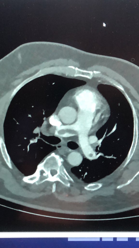 BridgetteMccabe's tweet photo. Great last few days @EinsteinIR                   Borderline massive PE, septal bowing, 89% on RA, trip leak. Single pass thromectomy with @Paul_BradyIR_MD Immediate reduction in pulmonary artery pressures and symptomatic improvement. Thanks to @EinsteinIR for an amazing 4 years! https://t.co/FxKN5tXQ3u