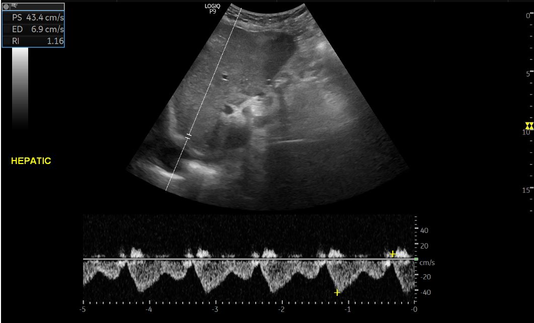 4/ Looks like the tank is empty....no wonder pt didn't tolerate ultrafiltration. #VExUS is not needed if IVC is small but just to make sure, hepatic and portal vein Doppler obtained - look normal!