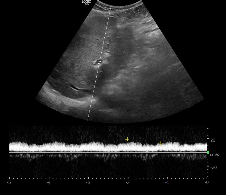 4/ Looks like the tank is empty....no wonder pt didn't tolerate ultrafiltration. #VExUS is not needed if IVC is small but just to make sure, hepatic and portal vein Doppler obtained - look normal!