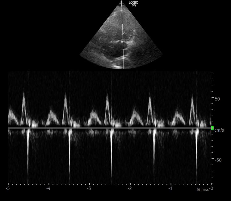 11/ Mitral inflow Doppler  #POCUS Impaired relaxation (A>E) but not unexpected in older people. Shouldn't fill the lung with B-lines. Tissue Doppler not performed.Need a refresher on diastology? Refer to  @Pocus101 's guide  https://www.pocus101.com/how-to-measure-and-grade-diastolic-dysfunction-using-echocardiography/