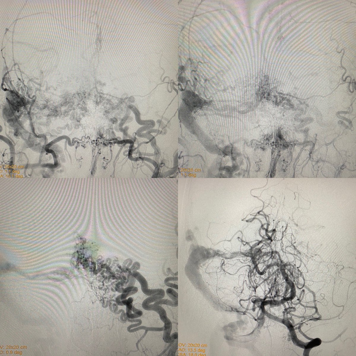 neuroabud's tweet photo. Ruptured dural AVF of an isolated right transverse sinus with cortical reflux to the Labbé vein. Approach from both MMAs (right and left) and right occipital artery using a balloon to control reflux. Simultaneous triple injection was performed until complete exclusion of the dAVF https://t.co/pwA6ASt8ez