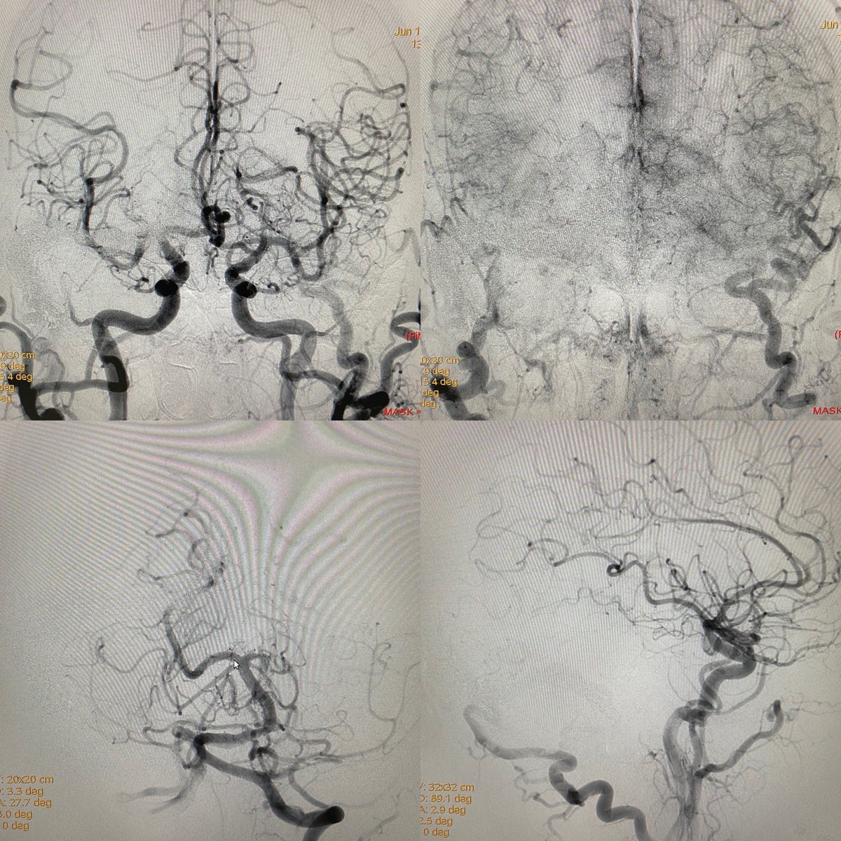 neuroabud's tweet photo. Ruptured dural AVF of an isolated right transverse sinus with cortical reflux to the Labbé vein. Approach from both MMAs (right and left) and right occipital artery using a balloon to control reflux. Simultaneous triple injection was performed until complete exclusion of the dAVF https://t.co/pwA6ASt8ez