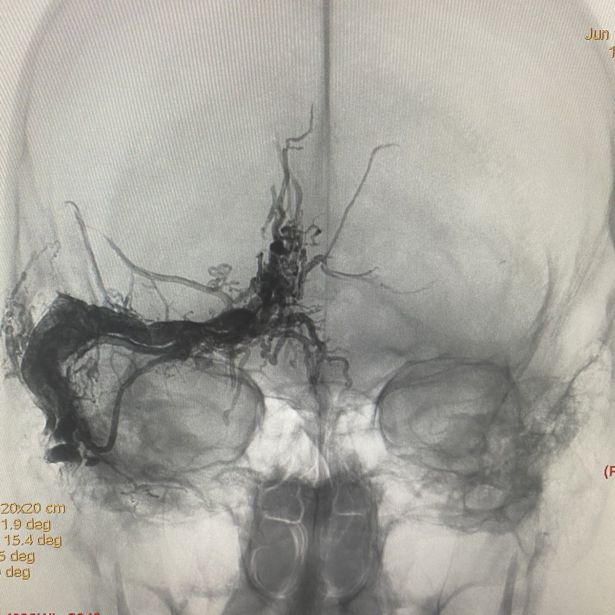 neuroabud's tweet photo. Ruptured dural AVF of an isolated right transverse sinus with cortical reflux to the Labbé vein. Approach from both MMAs (right and left) and right occipital artery using a balloon to control reflux. Simultaneous triple injection was performed until complete exclusion of the dAVF https://t.co/pwA6ASt8ez