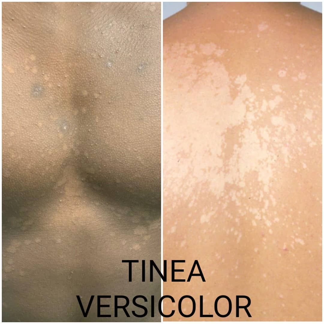 Tinea Versicolor Before And After