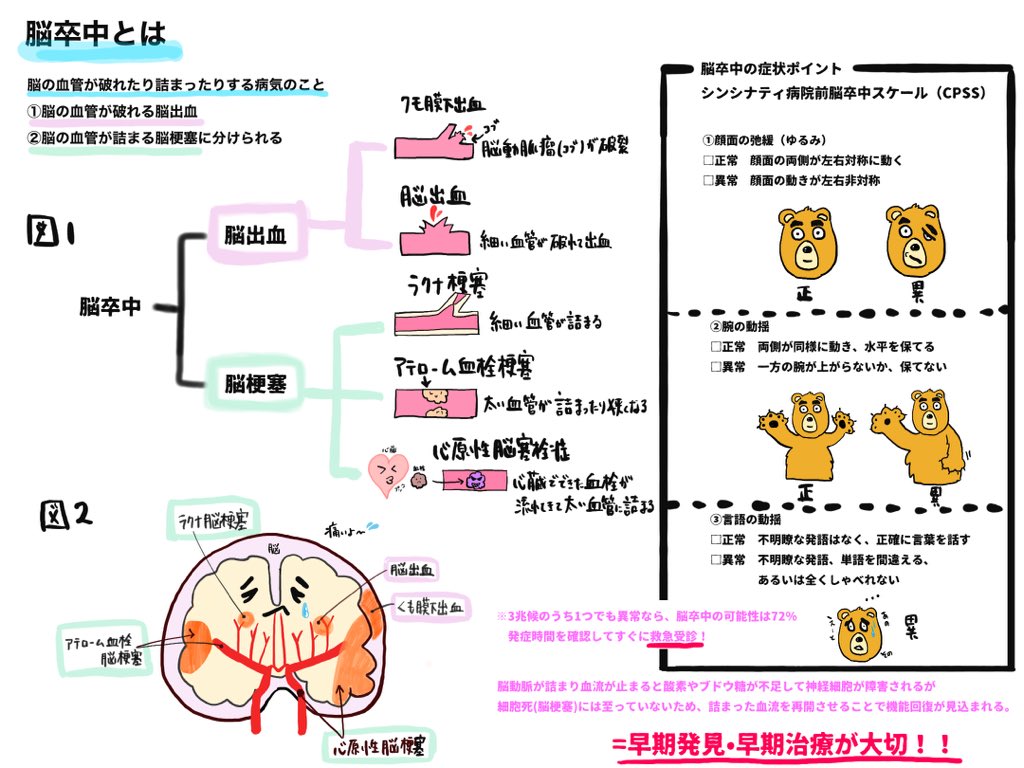 Ns Imoimo 脳卒中 簡単イラスト解説 看護師 看護師の勉強垢 看護師と繋がりたい イラストレーター イラスト好きな人と繋がりたい 介護士 脳出血 脳梗塞 軽美術部