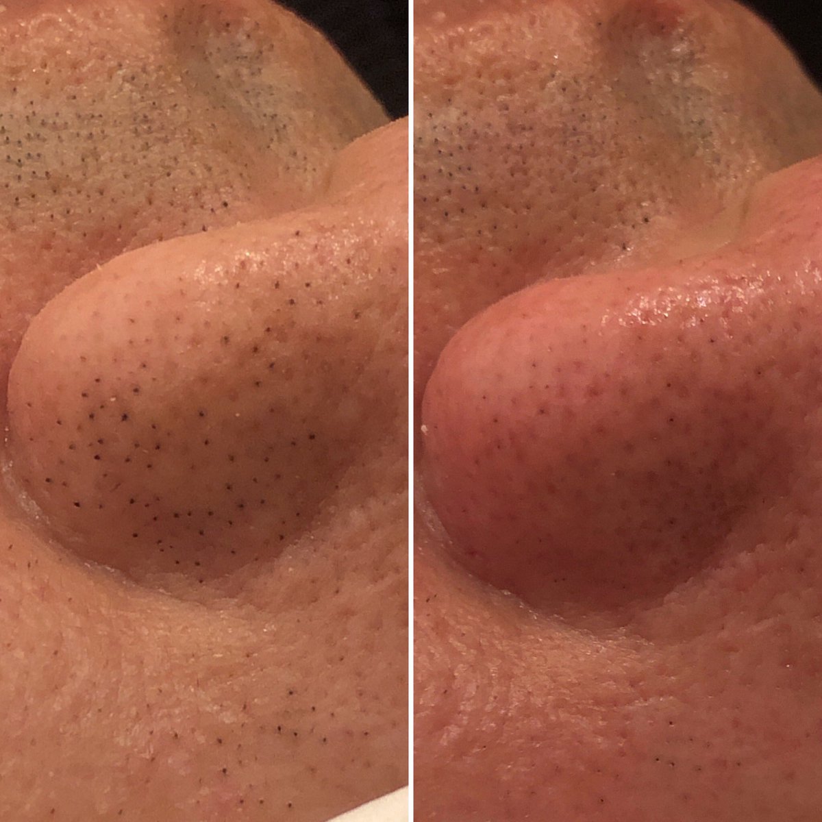 エクストラ クション 毛穴