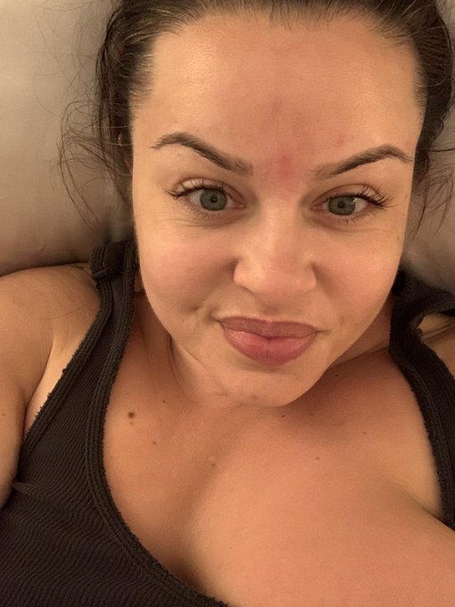 The Botox takes about 4-7 days to show but I am already super happy. I got a great deal because of my<a href="/tag/mvsales"class="tags"><span>#mvsales</span></a>